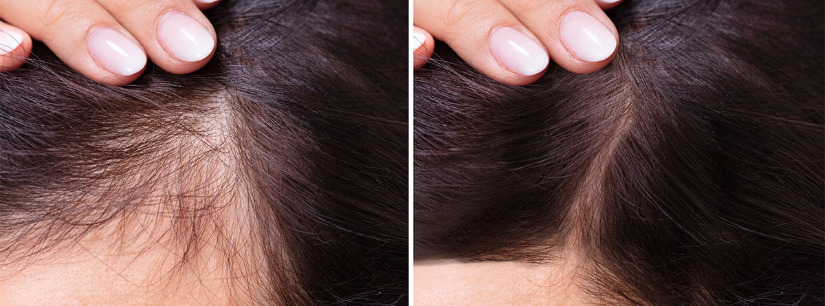 Mujer con pérdida de cabello