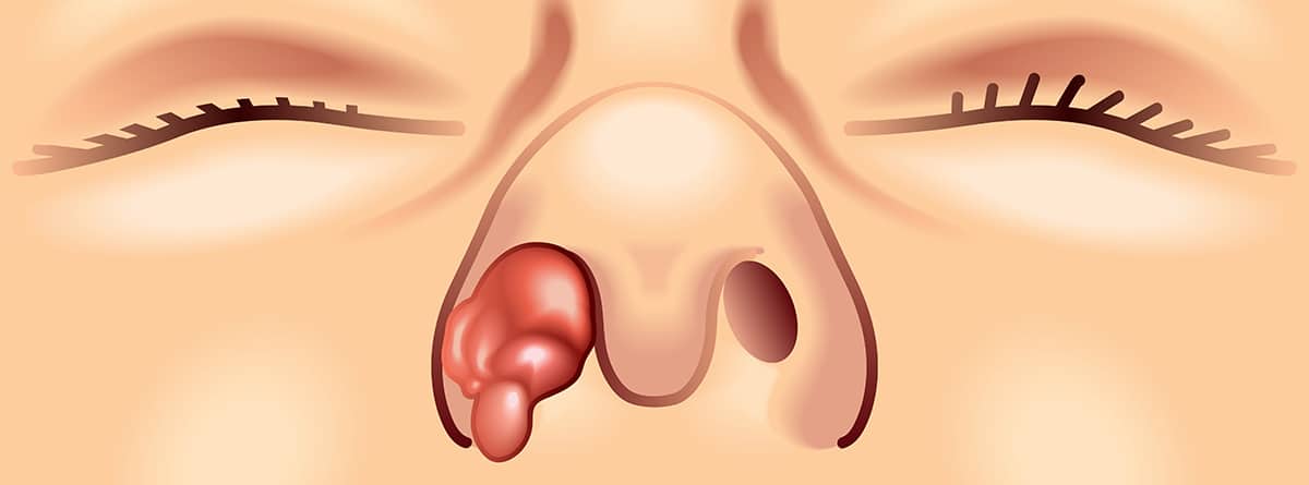 Ilustración tumor nasal