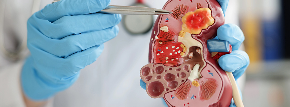 Maqueta de riñón enfermo