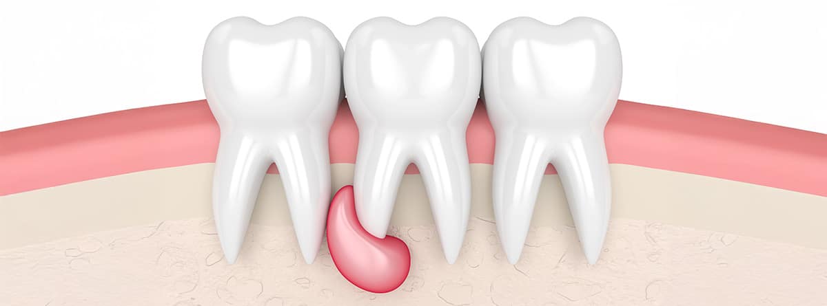 Ilustración absceso dental