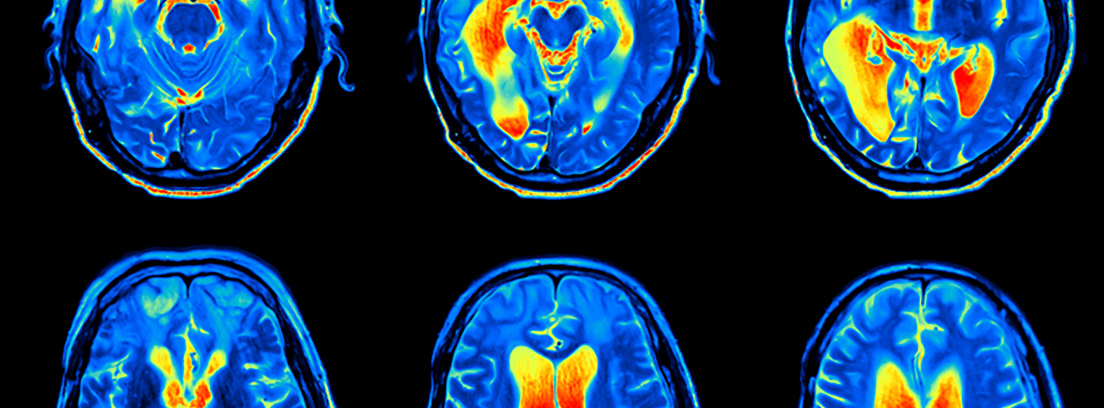accidente-cerebrovascular-que-es-3