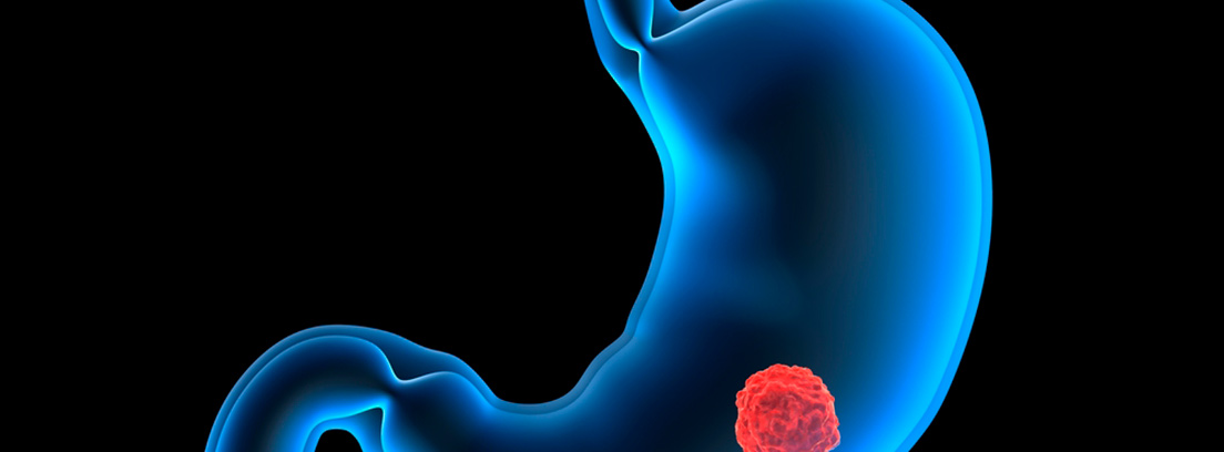 cancer-estomago-3
