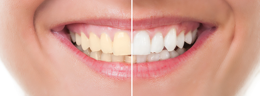 dientes-mas-blancos-3