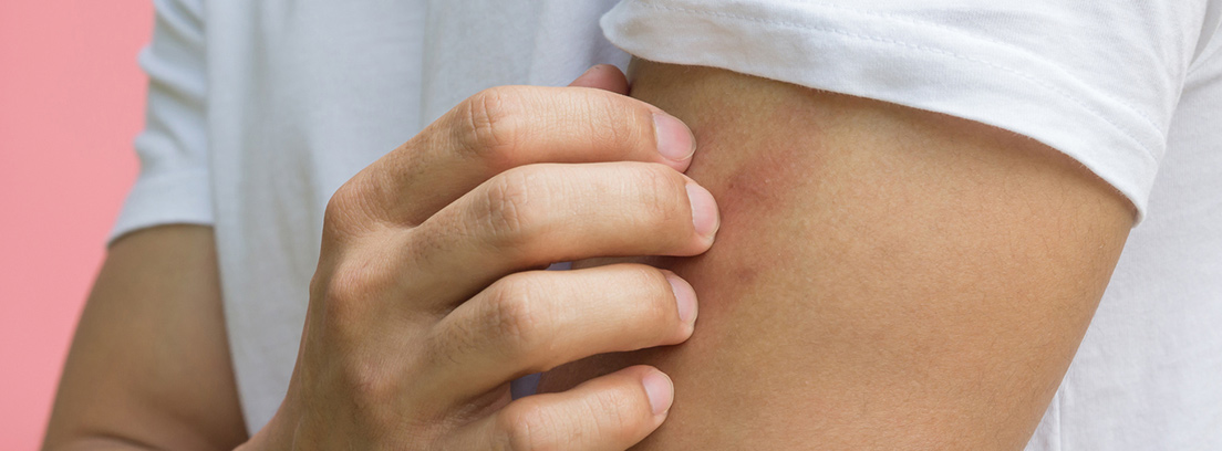 enfermedades-dishidrosis-3