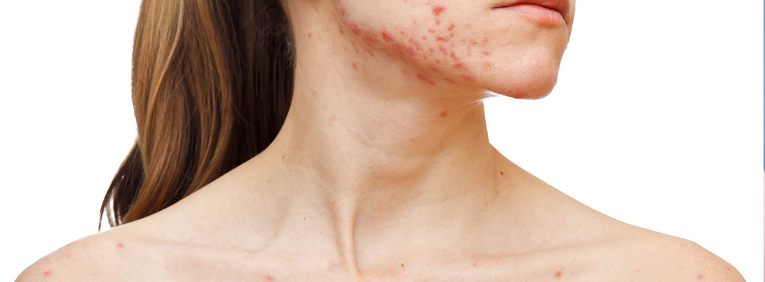 Epidermólisis bullosa: qué es, cómo se diagnostica, tratamiento… Mujer con enfermedad de piel Epidermólisis bullosa