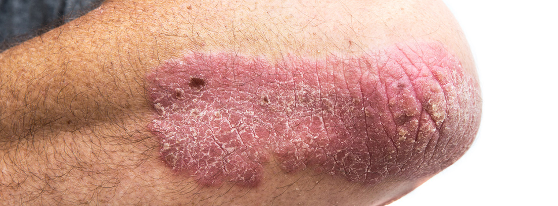 psriasis-que-es-3