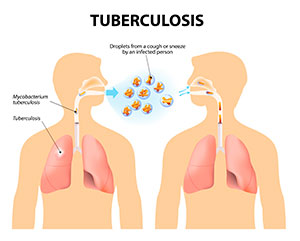 Resultado de imagen para imagenes sobre tuberculosis pulmonar