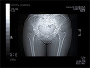 Salud Mujer. Enfermedades de la mujer. Alteraciones ginecológicas. Vaginosis bacteriana