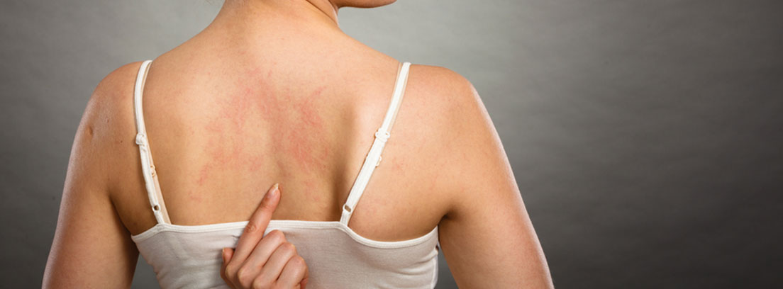 urticaria-acuagenica-entr