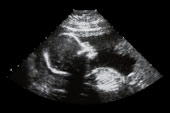 Salud Mujer. Esterilidad e Infertilidad femenina. Abortos de repetición