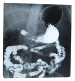 Salud Mayores. Patología digestiva en personas mayores. Malabsorción