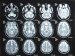 Salud Mayores. Neuro-psiquiatría en geriatría. Enfermedad cerebrovascular