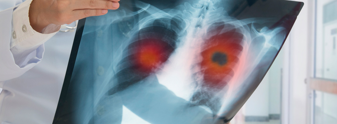 Coils pulmonar