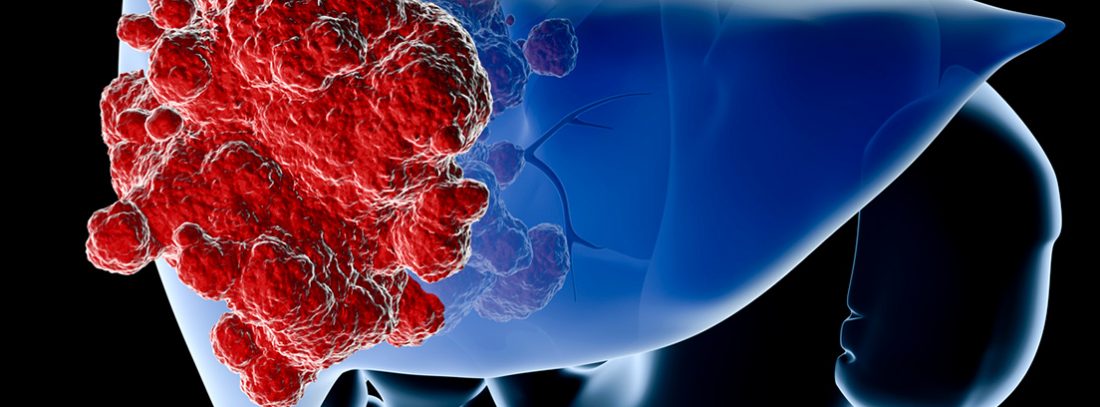 Hemangioma en el higado causas