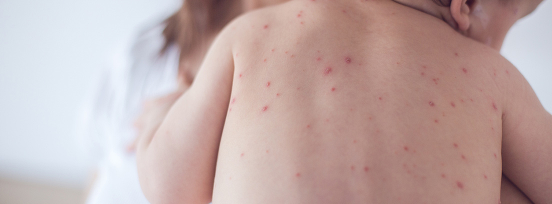 varicela espalda de un niño pequeño con varicela