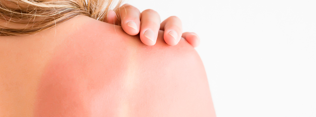 Los males del verano, cómo prevenirlos detalle de la espalda quemada por el sol de una mujer