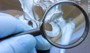 Radiografía de la cadera