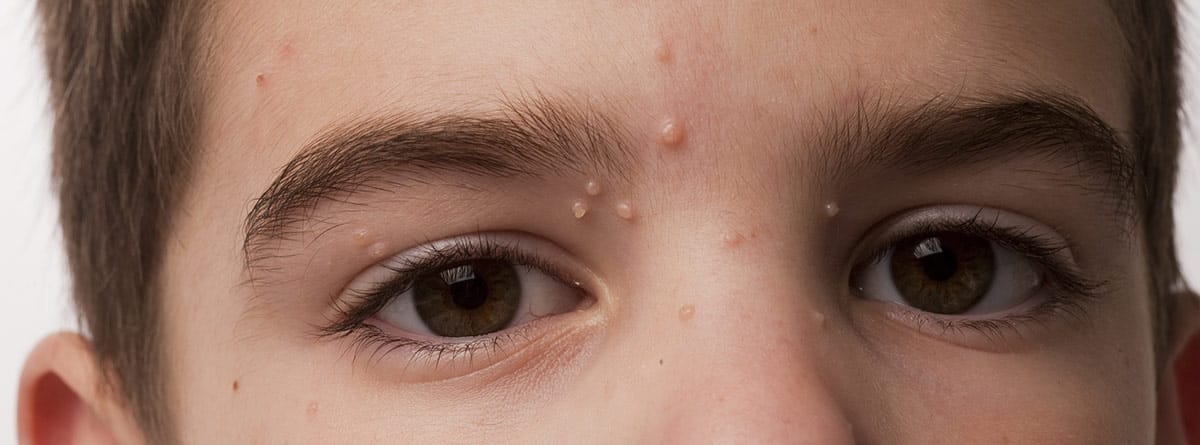 molusco-contagioso Molusco contagioso: cara de un niño con granitos de molusco