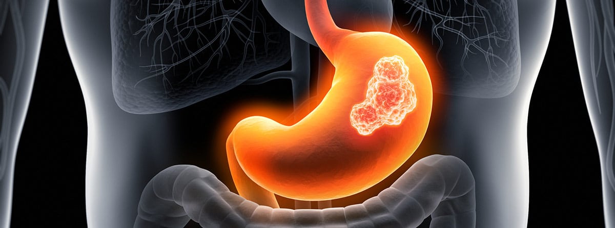 linforma-gastrico-1 Linfoma MALT gástrico: imagen de cáncer de estómagode
