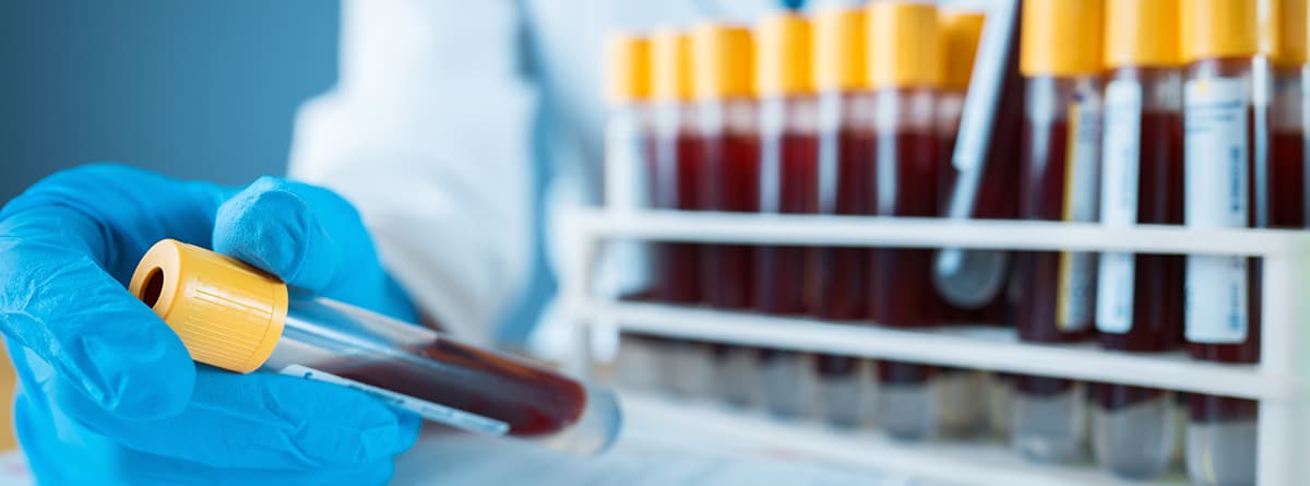 destacado-histamina analisis-de-sangre