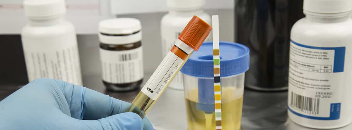 olor-en-la-orina Olor fuerte en la orina: vaso con muestra de orina y tubo de ensayo
