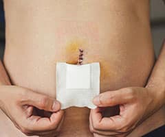 ¿Por qué se produce la hernia umbilical?: Herida recién cosida después de la operación de hernia umbilical del vientre.