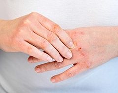 Eccemas y tipos: manos de mujer con lesiones en la piel