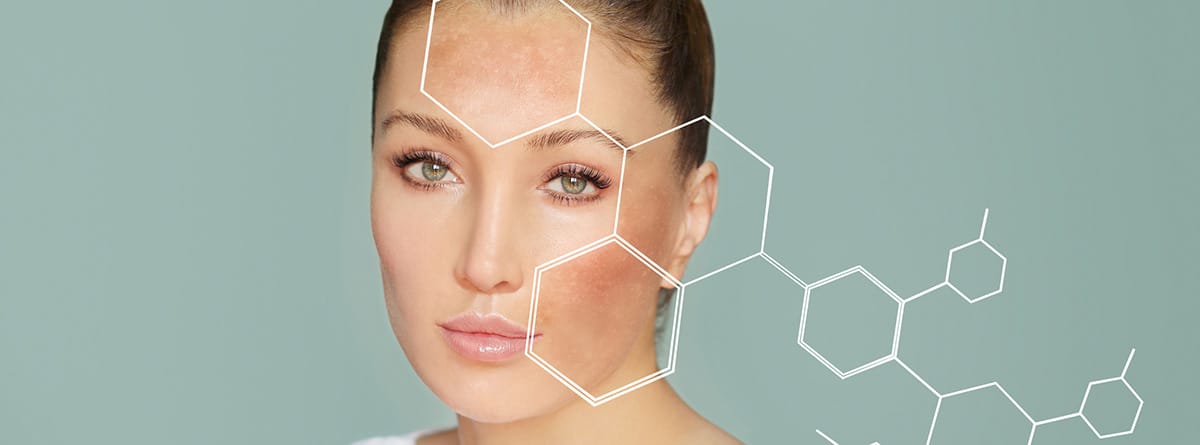 manchas en la piel Quitar manchas de la edad de la piel: mujer con el rostro con manchas