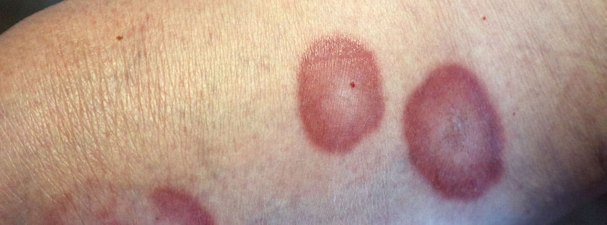 Granuloma anular Granuloma anular: pierna con manchas de granuloma anular