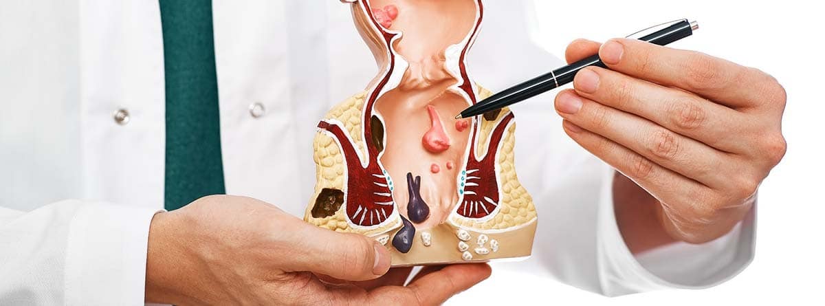 Médico señalando en una maqueta cómo se producen las hemorroides