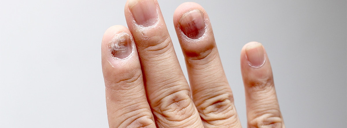 Uñas con hemorragia en la uña
