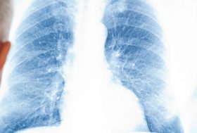 Doctor sujetando una radiografia pulmonar