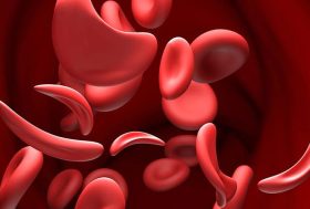 Anemia de células falciformes