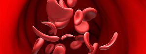 Anemia de células falciformes