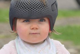 Bebé con casco correctivo braquicefalia