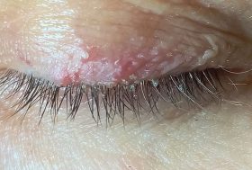 Dermatitis palpebral