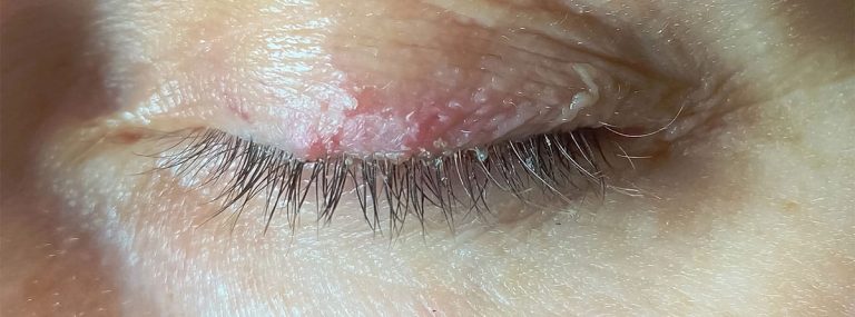 Dermatitis palpebral