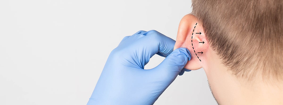 Otoplastia
