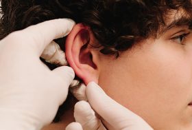 Otoplastia
