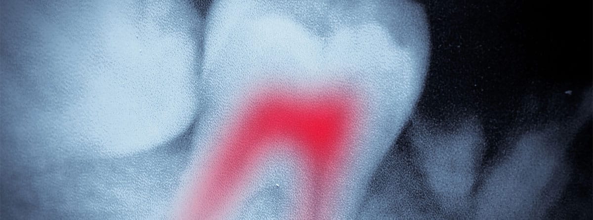 Radiografía molar