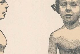 Ilustración de un niño con una deformidad estructural del tórax