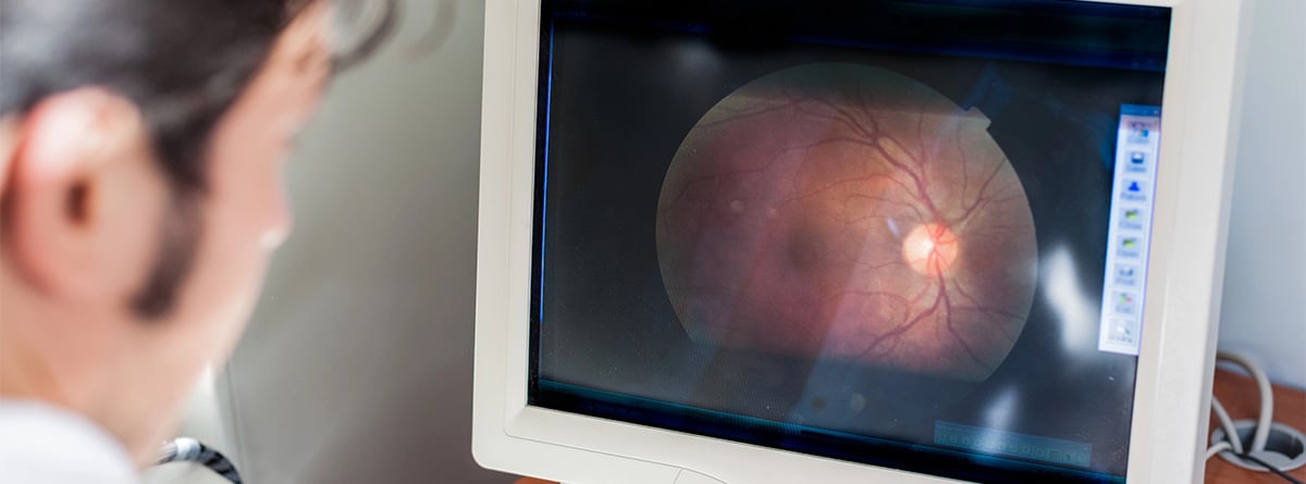 Agujero macular Revisión oculista
