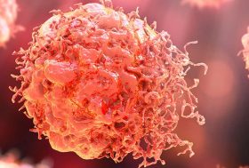 Imagen de un melanoma