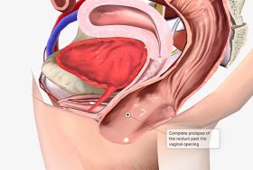 Ilustración 3d sobre prolapso rectal