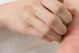 Mujer rascándose el brazo