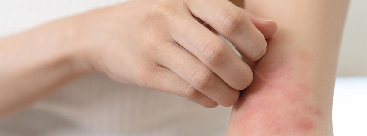 Dermatitis de contacto Mujer rascándose el brazo