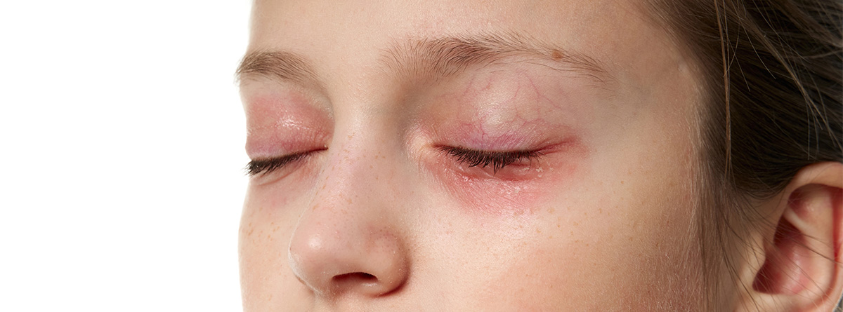 Rosácea ocular