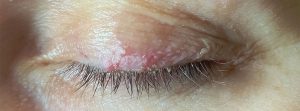 Rosácea ocular