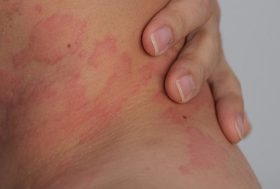 Piel con dermatitis