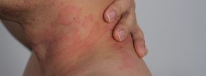 Piel con dermatitis